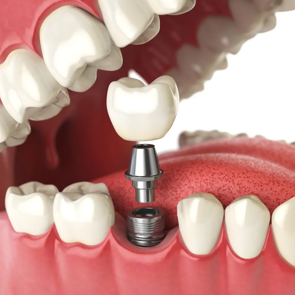implantes-dentales