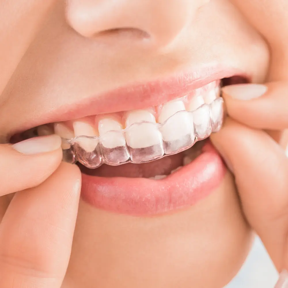 Invisalign-en-oviedo