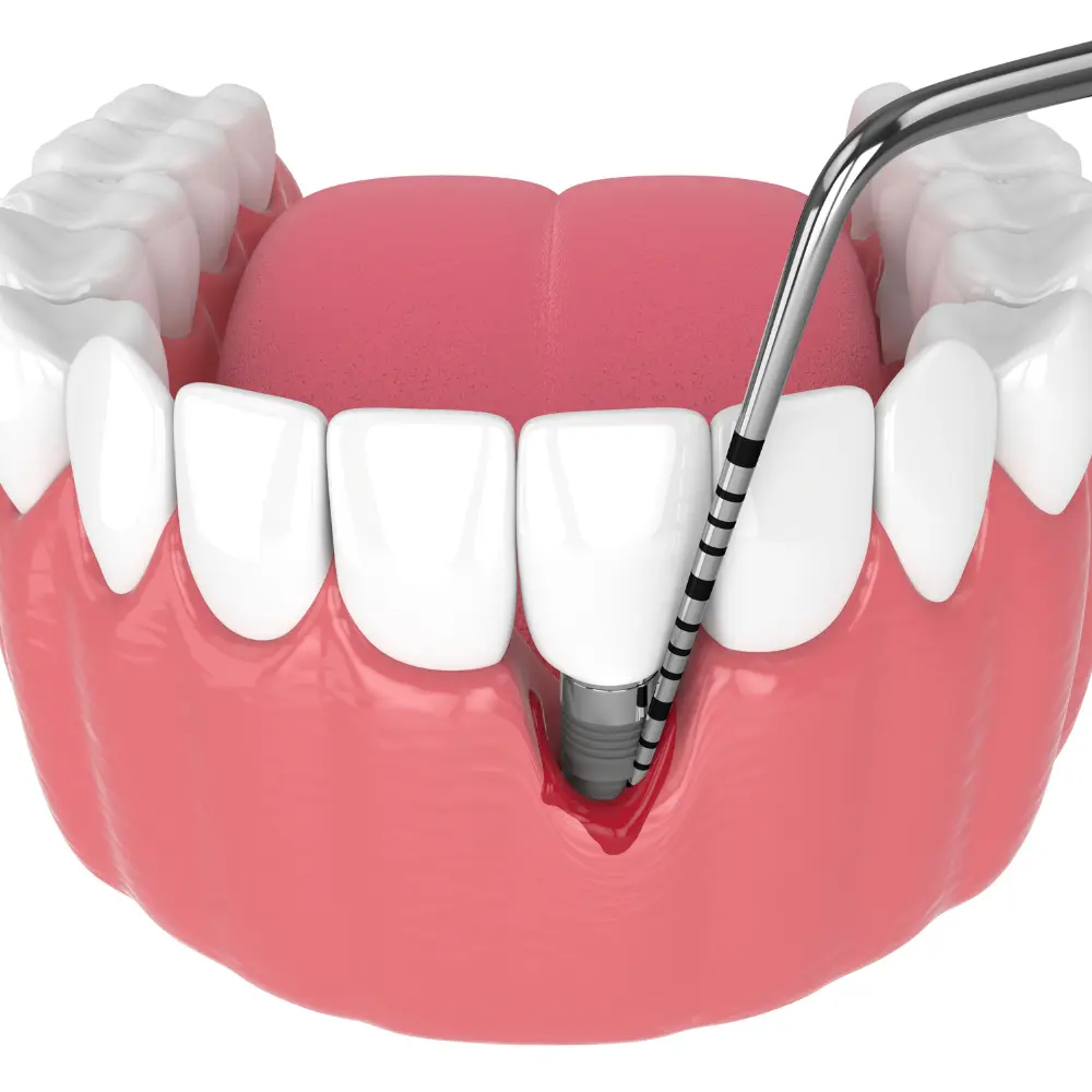 periodoncia